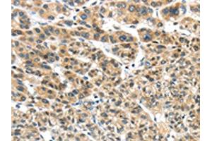 The image on the left is immunohistochemistry of paraffin-embedded Human liver cancer tissue using (TKTL1 Antibody) at dilution 1/40, on the right is treated with fusion protein. (TKTL1 anticorps)