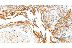 Immunohistochemistry of paraffin-embedded Human esophagus cancer using PLAT Polyclonal Antibody at dilution of 1:50 (PLAT anticorps)
