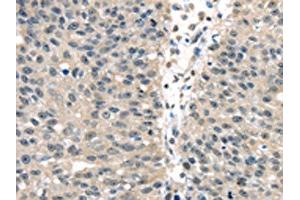 The image on the left is immunohistochemistry of paraffin-embedded Human breast cancer tissue using ABIN7128063(UCHL3 Antibody) at dilution 1/25, on the right is treated with fusion protein. (UCHL3 anticorps)