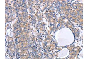 The image on the left is immunohistochemistry of paraffin-embedded Human thyroid cancer tissue using ABIN7190789(GFRA4 Antibody) at dilution 1/40, on the right is treated with synthetic peptide. (GFRA4 anticorps)