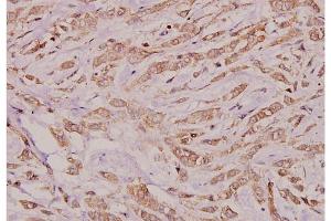 Immunohistochemistry analysis of Connexin-32 antibody in paraffin-embedded human breast carcinoma tissue at 1/100 dilution.