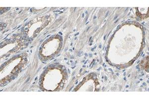 ABIN6277566 at 1/100 staining Human prostate tissue by IHC-P. (EEF2K anticorps  (Internal Region))
