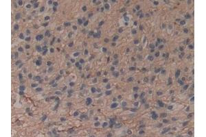 Detection of ANXA6 in Human Glioma Tissue using Polyclonal Antibody to Annexin A6 (ANXA6)
