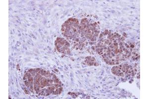 IHC-P Image Immunohistochemical analysis of paraffin-embedded NCIN87 xenograft, using ZNF259, antibody at 1:500 dilution. (ZNF259 anticorps  (Center))