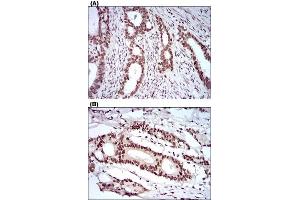 Immunohistochemical staining of cervical cancer tissues (A) and colon cancer tissues (B) with KHDRBS2 monoclonal antibody, clone 7G8C10  at 1:200-1:1000 dilution. (KHDRBS2 anticorps  (AA 160-349))