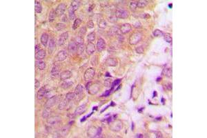 Immunohistochemical analysis of Caspase 6 staining in human prostate cancer formalin fixed paraffin embedded tissue section.