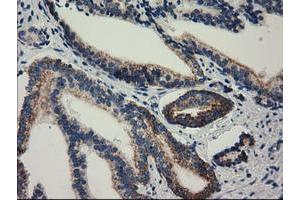 Immunohistochemical staining of paraffin-embedded Carcinoma of Human prostate tissue using anti-RASD2 mouse monoclonal antibody. (RASD2 anticorps)