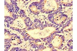 Immunohistochemistry of paraffin-embedded human colon cancer using ABIN7143463 at dilution of 1:100 (GGA1 anticorps  (AA 1-89))