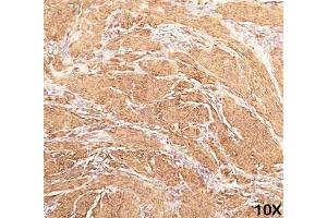 IHC staining of human leiomyosarcoma (10X) with Muscle actin antibody (HHF35). (Actin anticorps)
