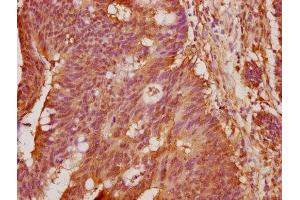 IHC image of ABIN7144476 diluted at 1:100 and staining in paraffin-embedded human colon cancer performed on a Leica BondTM system.