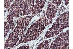 Immunohistochemical staining of paraffin-embedded Carcinoma of Human liver tissue using anti-ILVBL mouse monoclonal antibody. (ILVBL anticorps)