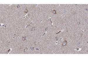 ABIN6276906 at 1/100 staining Human brain cancer tissue by IHC-P. (IL-10RA anticorps  (C-Term))
