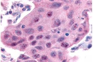 Anti-ESRRA antibody  ABIN1048580 IHC staining of human breast carcinoma. (ESRRA anticorps  (Internal Region))