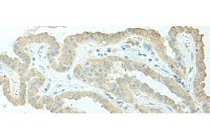 Immunohistochemistry of paraffin-embedded Human thyroid cancer tissue using EVI2B Polyclonal Antibody at dilution of 1:40(x200) (EVI2B anticorps)