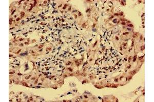 Immunohistochemistry analysis of human lung cancer using ABIN7142618 at dilution of 1:100