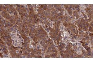 ABIN6277377 at 1/100 staining Human liver cancer tissue by IHC-P. (Metabotropic Glutamate Receptor 1 anticorps  (Internal Region))
