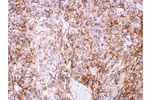 IHC-P Image Immunohistochemical analysis of paraffin-embedded Ca922 xenograft, using Adenosine A2a Receptor, antibody at 1:500 dilution.