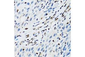 Immunohistochemistry of paraffin-embedded human lung cancer using FLI1 antibody (ABIN1876845) at dilution of 1:100 (40x lens). (FLI1 anticorps)