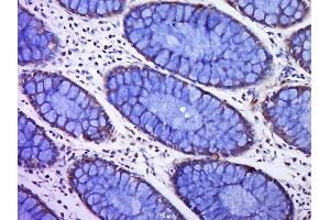 Paraformaldehyde-fixed, paraffin embedded human colon cancer, Antigen retrieval by boiling in sodium citrate buffer (pH6. (C12orf42 anticorps)