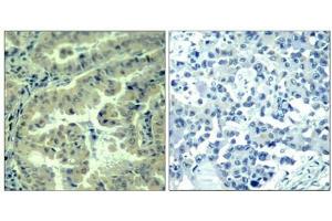 Immunohistochemical analysis of paraffin-embedded human lung carcinoma tissue using eIF4G(Phospho-Ser1232) Antibody(left) or the same antibody preincubated with blocking peptide(right).
