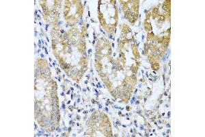 Immunohistochemistry of paraffin-embedded human gastric cancer using ASIP antibody at dilution of 1:100 (40x lens). (ASIP anticorps)
