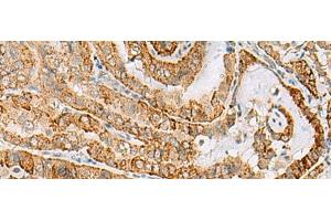 Immunohistochemistry of paraffin-embedded Human thyroid cancer tissue using FARP2 Polyclonal Antibody at dilution of 1:70(x200) (FARP2 anticorps)