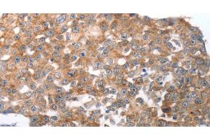 Immunohistochemistry of paraffin-embedded Human breast cancer using NQO2 Polyclonal Antibody at dilution of 1:50 (NQO2 anticorps)