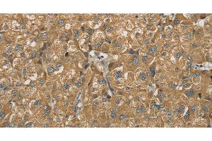 Immunohistochemistry of paraffin-embedded Human liver cancer using SDHB Polyclonal Antibody at dilution of 1:30
