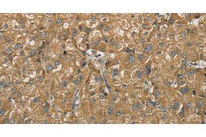 Immunohistochemistry of paraffin-embedded Human liver cancer using SDHB Polyclonal Antibody at dilution of 1:30 (SDHB anticorps)