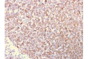 Formalin-fixed, paraffin-embedded human Lymphoma stained with Monospecific Mouse Monoclonal Antibody to LSP1 (LSP1/3025).