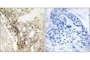 Immunohistochemistry analysis of paraffin-embedded human breast carcinoma tissue, using MED21 Antibody. (MED21 anticorps  (AA 71-120))