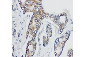 Anti-CD1d antibody, IHC(P) IHC(P): Human Mammary Cancer Tissue (CD1d anticorps  (N-Term))