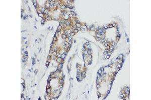 Anti-CD1d antibody, IHC(P) IHC(P): Human Mammary Cancer Tissue