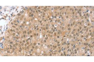 Immunohistochemistry of paraffin-embedded Human breast cancer using TRIM35 Polyclonal Antibody at dilution of 1:35 (TRIM35 anticorps)