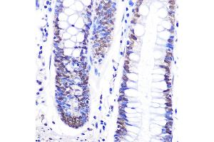 Immunohistochemistry of paraffin-embedded human colon using Snail Rabbit pAb (ABIN6134928, ABIN6148176, ABIN6148179 and ABIN6215911) at dilution of 1:100 (40x lens). (SNAIL anticorps  (C-Term))