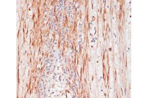 Immunohistochemistry of paraffin-embedded Human appendix using Phospho-PEA15(S104) Polyclonal Antibody at dilution of 1:100 (40x lens). (PEA15 anticorps  (pSer104))