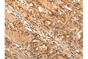 The image on the left is immunohistochemistry of paraffin-embedded Human gastic cancer tissue using ABIN7189699(ADRA1B Antibody) at dilution 1/20, on the right is treated with synthetic peptide. (ADRA1B anticorps)