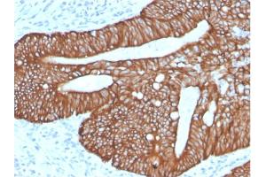 Formalin-fixed, paraffin-embedded human Colon Carcinoma stained with Cytokeratin 18Rabbit Recombinant Monoclonal Antibody (KRT18/2819R). (Recombinant Cytokeratin 18 anticorps)