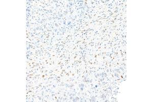 Immunohistochemistry (IHC) image for anti-Zinc Finger E-Box Binding Homeobox 1 (ZEB1) (AA 750-800) antibody (ABIN7455173) (Recombinant ZEB1 anticorps  (AA 750-800))