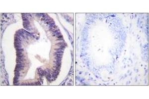 Immunohistochemistry analysis of paraffin-embedded human colon carcinoma tissue, using PFKFB2 (Ab-483) Antibody. (PFKFB2 anticorps  (AA 451-500))