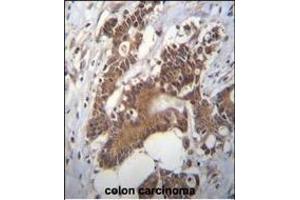 PCYT1A Antibody (N-term) (ABIN656103 and ABIN2845445) immunohistochemistry analysis in formalin fixed and paraffin embedded human colon carcinoma followed by peroxidase conjugation of the secondary antibody and DAB staining. (PCYT1A anticorps  (N-Term))