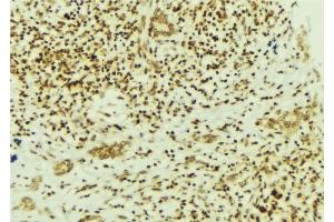 ABIN6269322 at 1/100 staining Human breast cancer tissue by IHC-P. (FAK anticorps  (Internal Region))