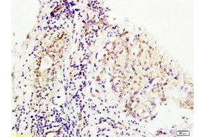 Formalin-fixed and human breast carcinoma tissue labeled with Anti-MMS19 Polyclonal Antibody, Unconjugated at 1:200 followed by conjugation to the secondary antibody and DAB staining (MMS19 anticorps  (AA 851-950))