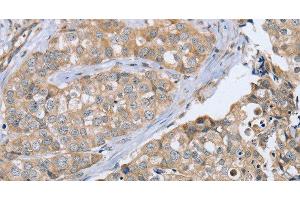 Immunohistochemistry of paraffin-embedded Human breast cancer using CYTH1 Polyclonal Antibody at dilution of 1:40 (Cytohesin 1 anticorps)