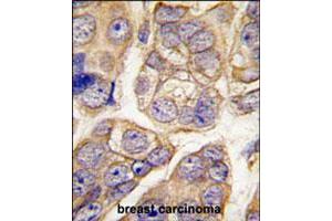 Formalin-fixed and paraffin-embedded human breast carcinoma tissue reacted with CDH13 polyclonal antibody  , which was peroxidase-conjugated to the secondary antibody, followed by DAB staining. (Cadherin 13 anticorps  (C-Term))