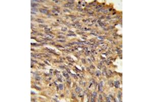 Immunohistochemistry in formalin-fixed and paraffin-embedded human lung carcinoma reacted with Vigilin / HDLBP Antibody (Center) followed which was peroxidase-conjugated to the secondary antibody, followed by DAB staining. (HDLBP anticorps  (Middle Region))