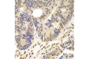 Immunohistochemistry of paraffin-embedded human colon carcinoma using LHX4 antibody at dilution of 1:100 (x400 lens). (LHX4 anticorps)