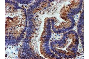 Immunohistochemical staining of paraffin-embedded Adenocarcinoma of Human colon tissue using anti-PDIA4 mouse monoclonal antibody. (PDIA4 anticorps)