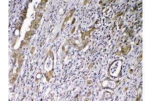 IHC testing of FFPE human rectal cancer tissue with VDBP antibody at 1ug/ml. (Vitamin D-Binding Protein anticorps)