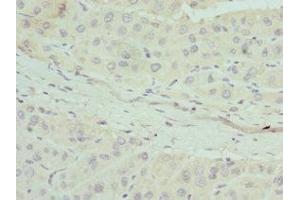 Immunohistochemistry of paraffin-embedded human liver cancer using ABIN7144441 at dilution of 1:100 (Apolipoprotein M anticorps  (AA 23-188))